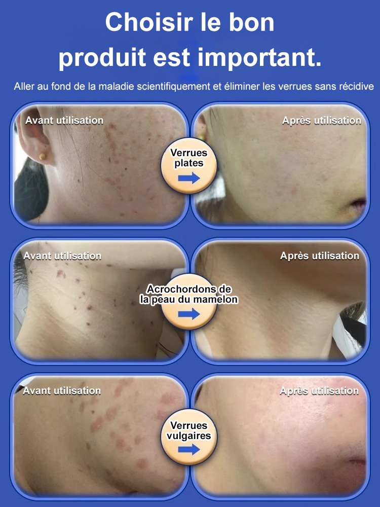 Gel médical antipyrétique Verrucoqingning