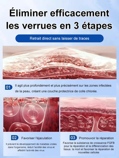 Gel médical antipyrétique Verrucoqingning