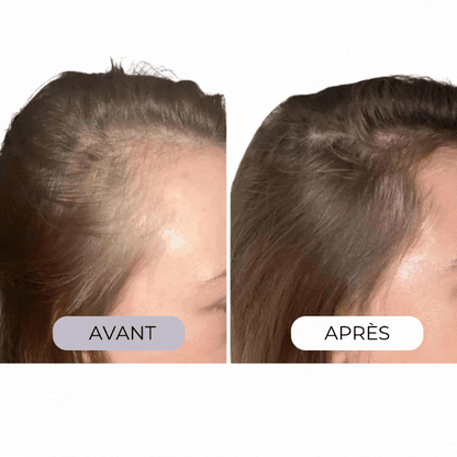 Micro-infusion capillaire régénérante